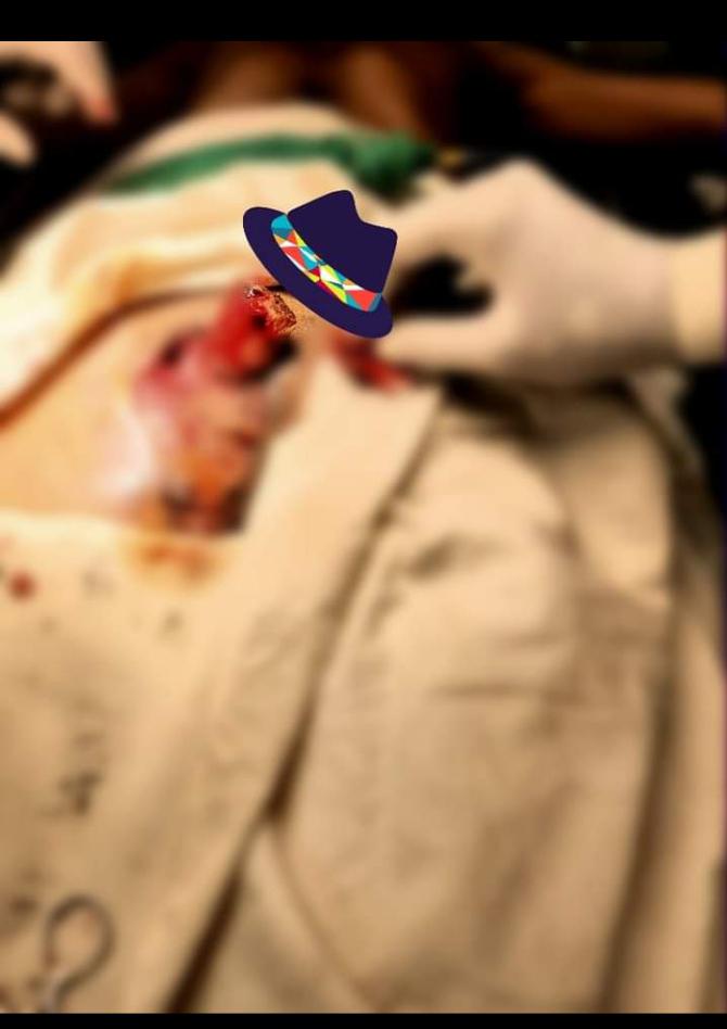 পেনিসের ইনজুরি/ পেনিস কেটে যাওয়া