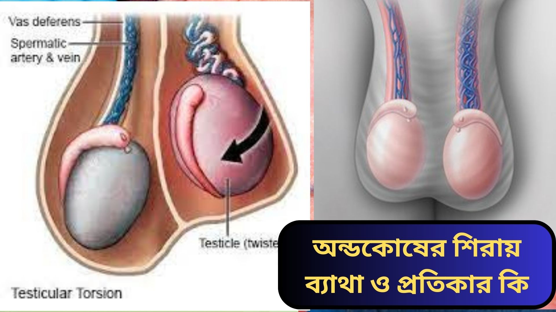অন্ডকোষের শিরায় ব্যাথা ও প্রতিকার কি । রগ ফুলে যাওয়া কারন