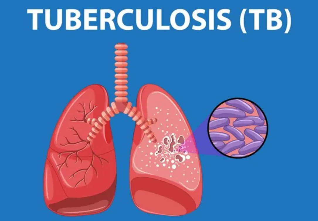 Treatment-intolerant pulmonary TB (tuberculosis)?