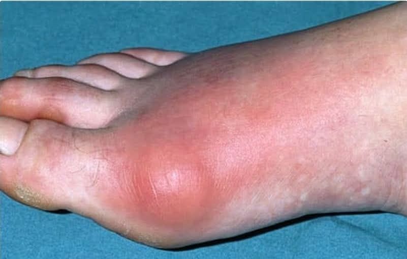 শীতে ইউরিক অ্যাসিড বাড়ে?