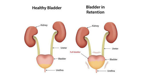 প্রস্রাব আটকে যাওয়া